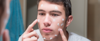 Acne